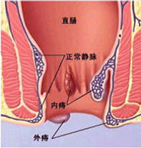 痔疮病理图