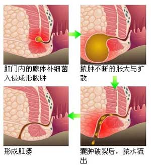 肛周脓肿与肛瘘